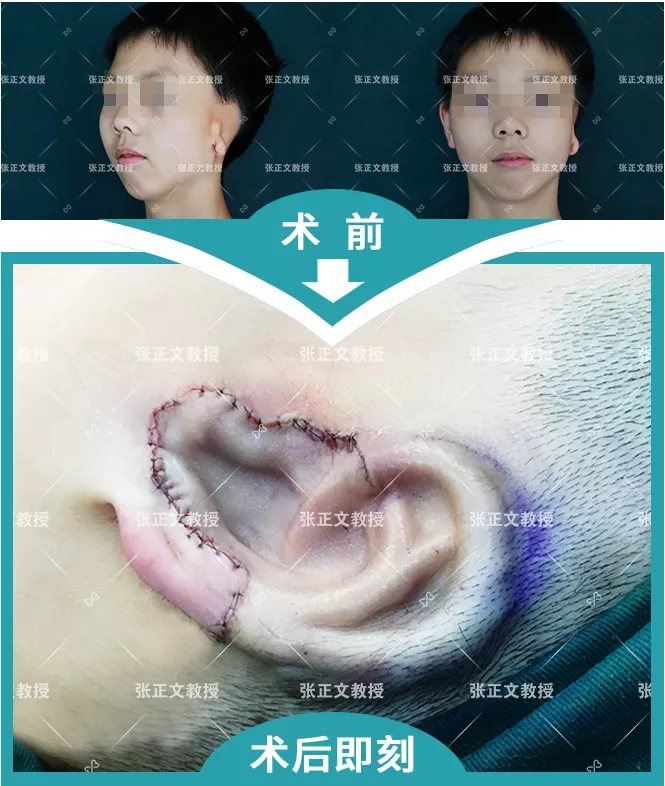 张正文教授为小铠做了耳再造手术，让他离梦想更进一步！