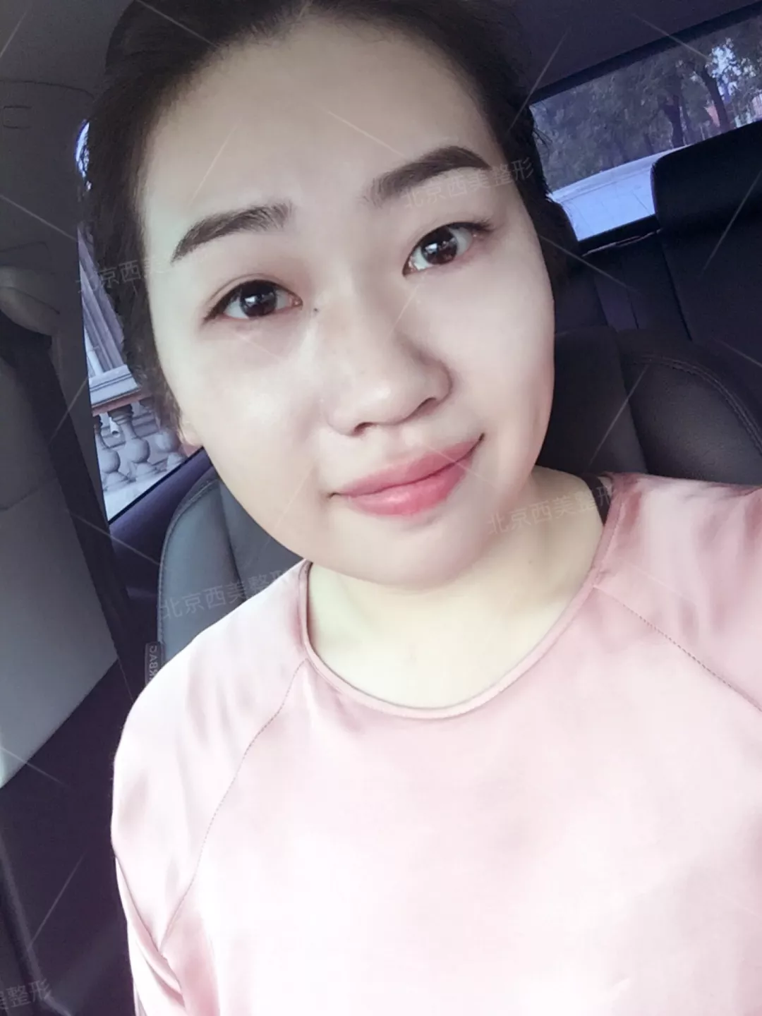 谢双灵案例有吗？谢双灵双眼皮真实记录——伊美尔健翔医院