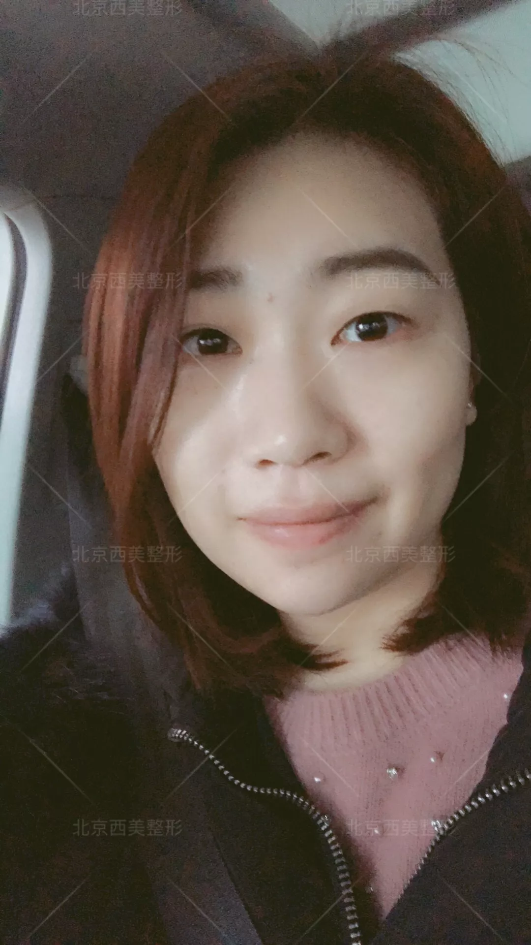 谢双灵案例有吗？谢双灵双眼皮真实记录——伊美尔健翔医院