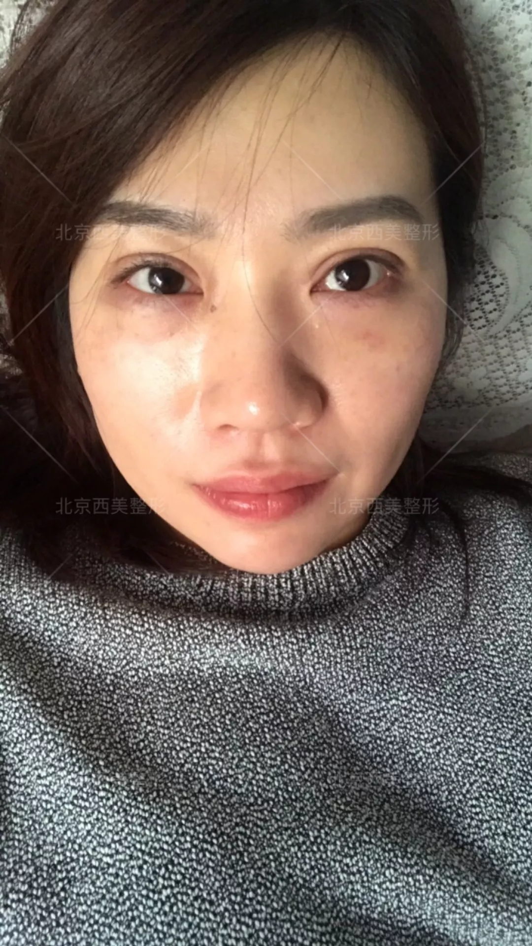 谢双灵案例有吗？谢双灵双眼皮真实记录——伊美尔健翔医院