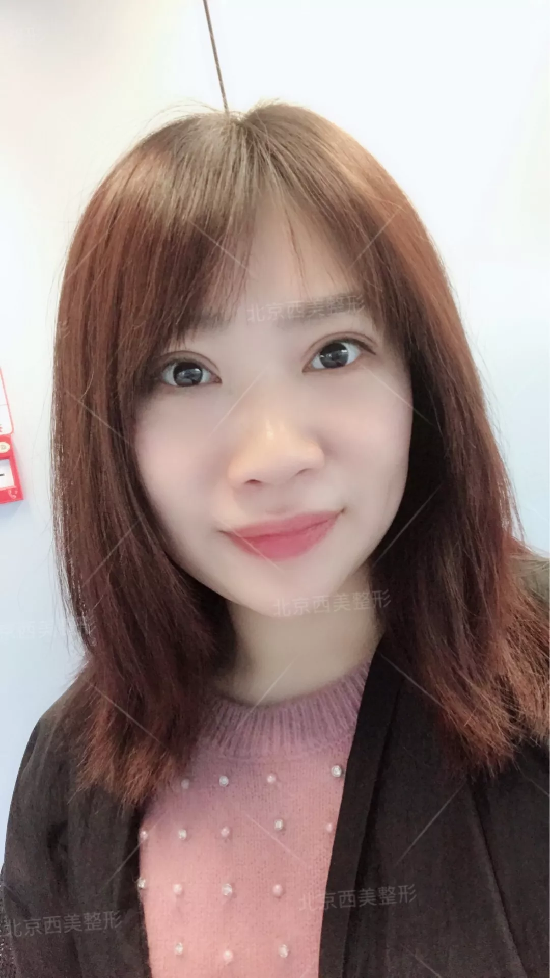 谢双灵案例有吗？谢双灵双眼皮真实记录——伊美尔健翔医院