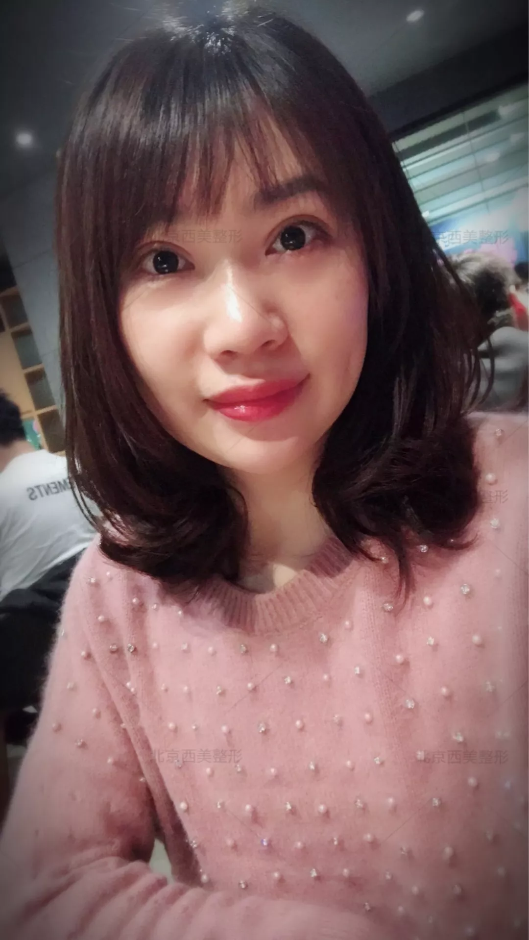 谢双灵案例有吗？谢双灵双眼皮真实记录——伊美尔健翔医院