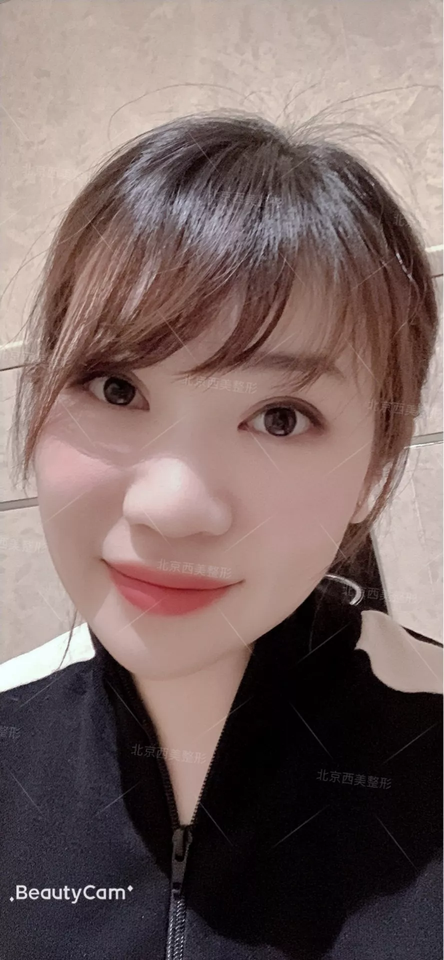 谢双灵案例有吗？谢双灵双眼皮真实记录——伊美尔健翔医院