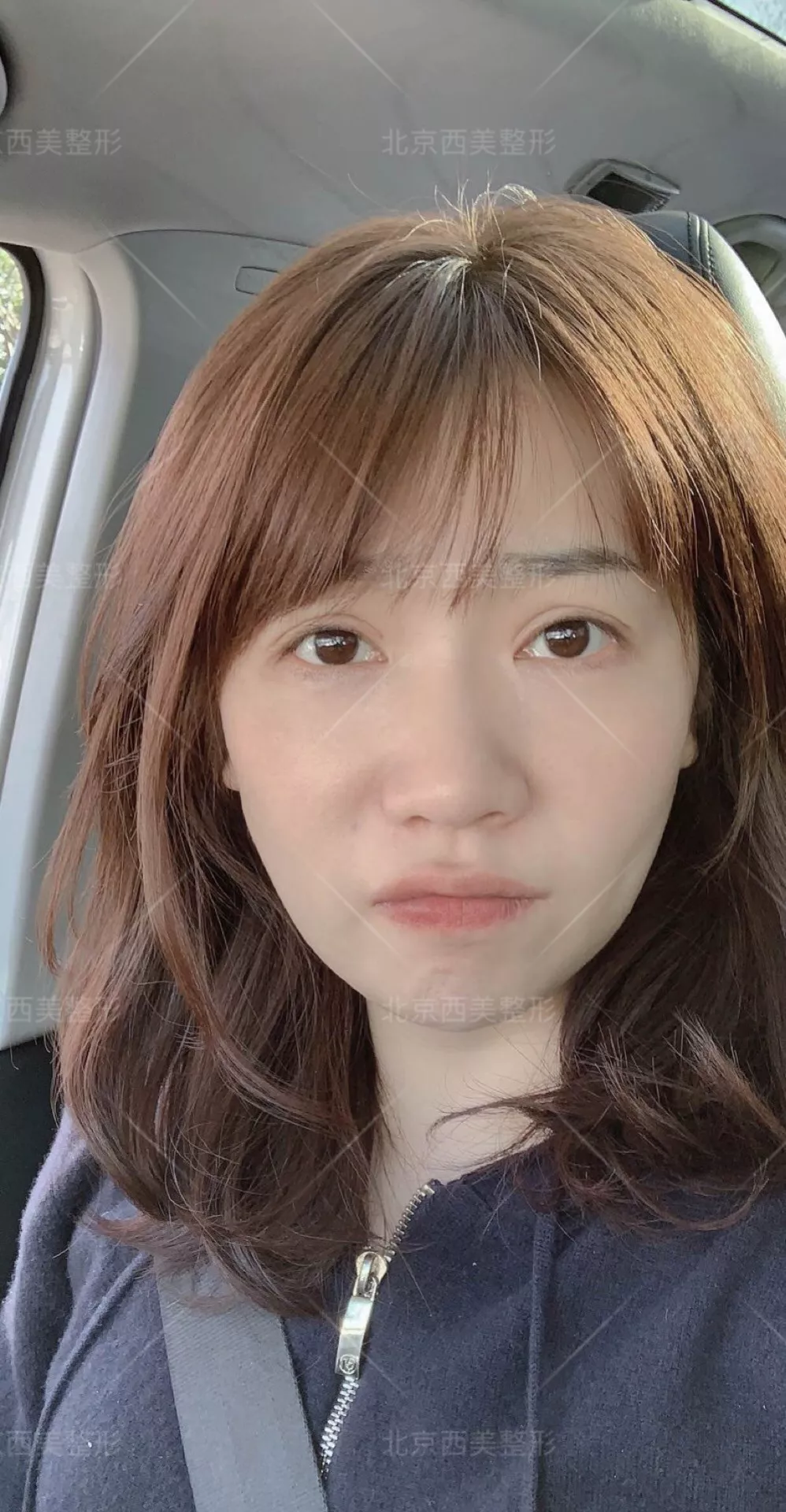 谢双灵案例有吗？谢双灵双眼皮真实记录——伊美尔健翔医院