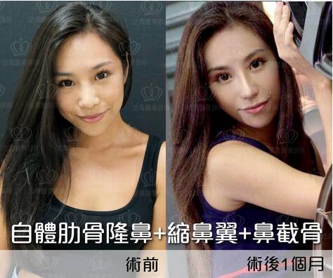 王艇隆鼻为什么这么贵？先来看下王艇隆鼻果图吧！