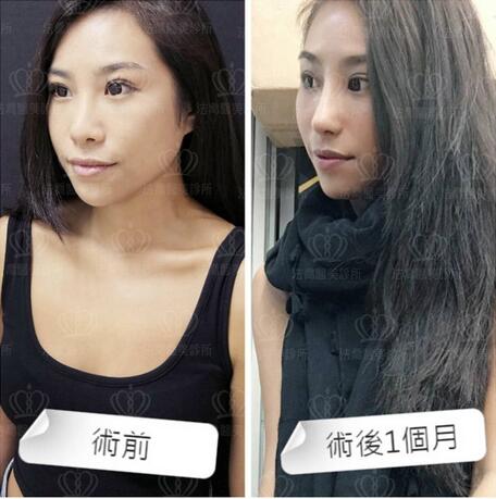 王艇隆鼻为什么这么贵？先来看下王艇隆鼻果图吧！