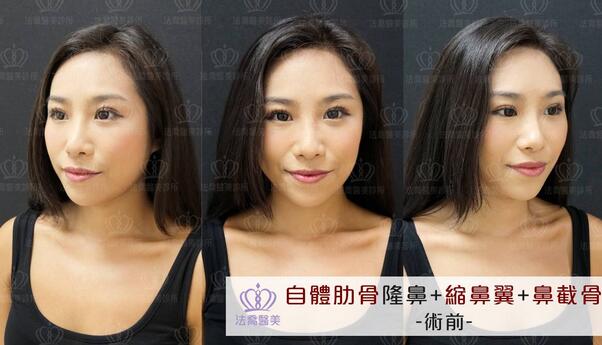 王艇隆鼻为什么这么贵？先来看下王艇隆鼻果图吧！
