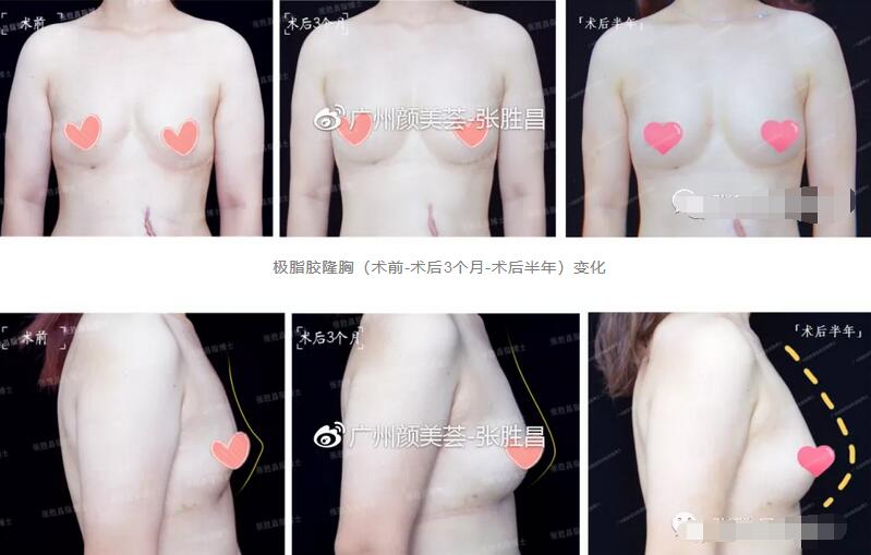 张胜昌极脂胶隆胸后半年：我老公当然满意，毕竟他是第一受益者~