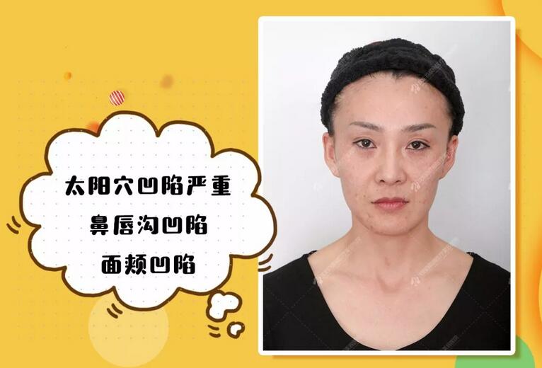 沈阳百嘉丽侯亚杰艾莉薇玻尿酸填充面部，一起来见证蜕变！