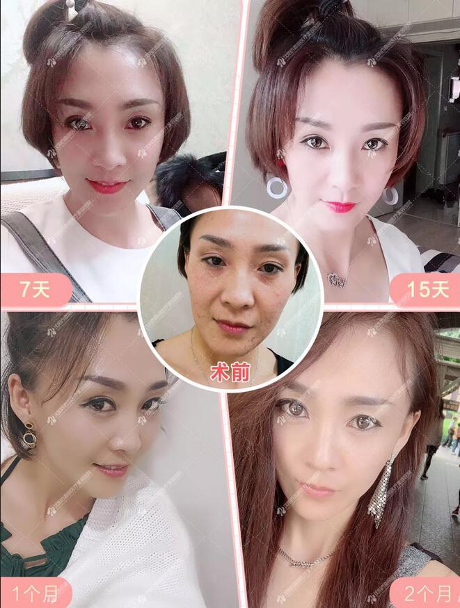 沈阳百嘉丽侯亚杰艾莉薇玻尿酸填充面部，一起来见证蜕变！