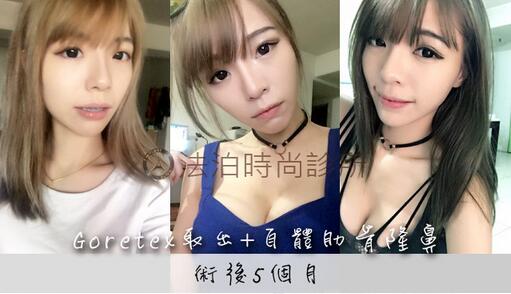 戈尔特斯取出+自体肋骨隆鼻术后5个月果图分享，请笑纳！
