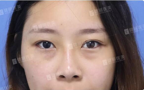 光乳化祛眼袋后的24岁女模特，竟笑出两对卧蚕？