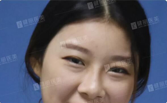 光乳化祛眼袋后的24岁女模特，竟笑出两对卧蚕？