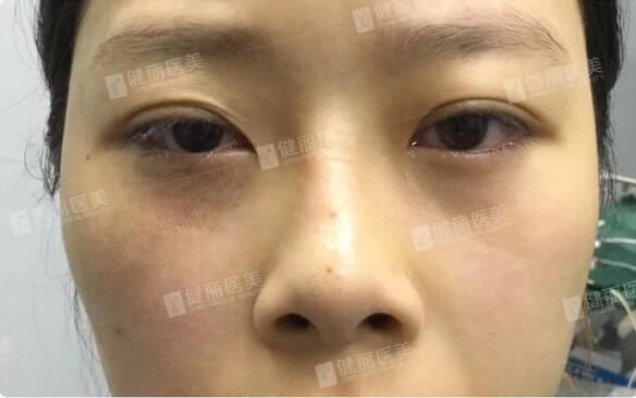 光乳化祛眼袋后的24岁女模特，竟笑出两对卧蚕？