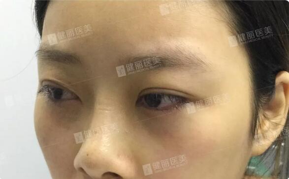 光乳化祛眼袋后的24岁女模特，竟笑出两对卧蚕？