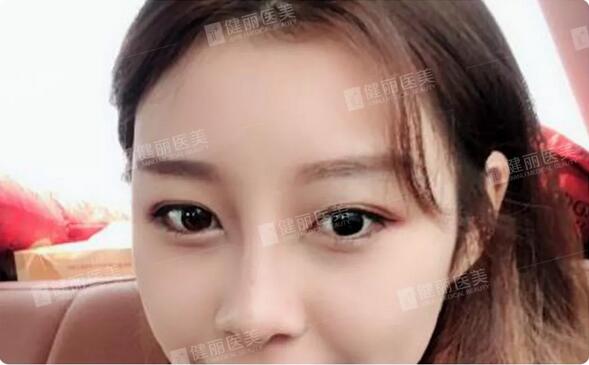 光乳化祛眼袋后的24岁女模特，竟笑出两对卧蚕？