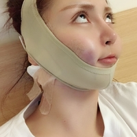 尖下颌角整形果如何?能否让我小巧又可爱