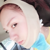 尖下颌角整形果如何?能否让我小巧又可爱