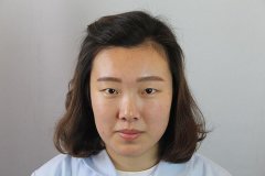 武汉中墺整形医院切开双眼皮+开内眼角36天惊人转变~ width=