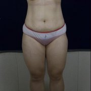 刘世铭环形大腿吸脂摆脱大象腿：15天前后对比照分享 width=