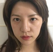 刘仁生切开双眼皮+提肌对比图分享：恢复只用了60天 width=