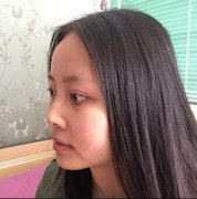 深圳广济医院鼻部手术改良鼻翼肥大真实案例对比图分享 width=