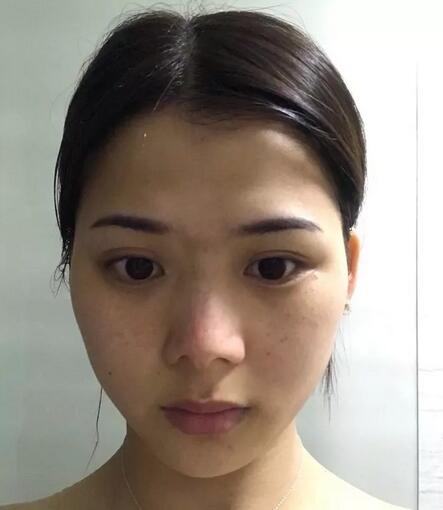 江门华美王文仿生隆鼻做得咋样喃？这里有一则案例哟！