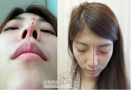硅胶隆鼻假体取出术+自体肋软骨隆鼻后，呱呱重拾自信!