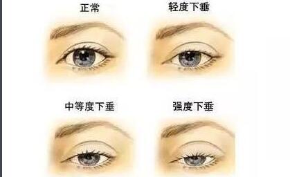 上睑下垂矫正术的禁忌症有哪些?