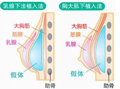 双C双平面丰胸果是******的吗?