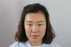 沈阳名流美容医院单眼皮切开双眼皮案例对比 width=