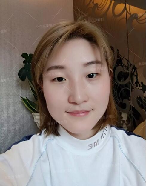 北京西美整形双眼皮真实案例一则，恢复记录给你看！