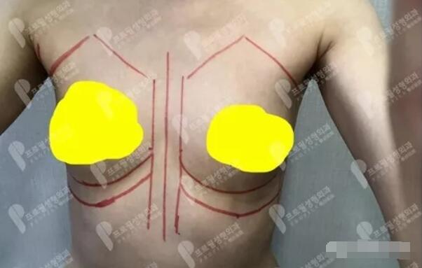 妙桃琴面假体隆胸术后恢复手记——平胸妹子的逆袭之旅~