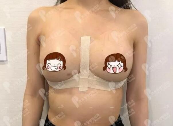 妙桃琴面假体隆胸术后恢复手记——平胸妹子的逆袭之旅~