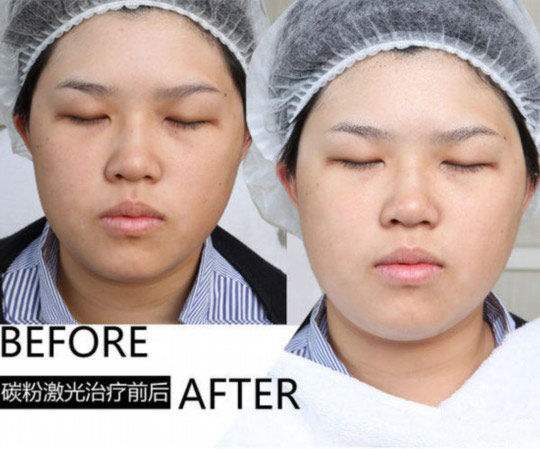 黑脸娃娃前后对比图|黑脸娃娃前后差异究竟有好大?