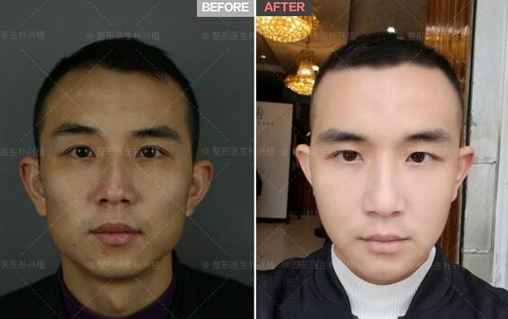 去颊脂垫对比图片，去颊脂垫果究竟咋个样喃？