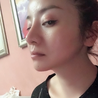 下巴吸脂恢复过程图片分享，从此告别双下巴