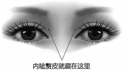 内眦赘皮矫正术果好不好?