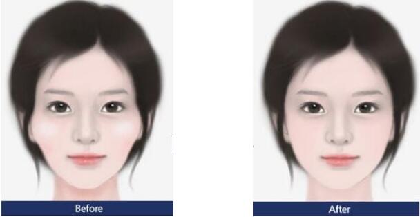 颧骨内推好吗?听起来有点危险呢?