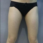 常熟瑞丽医院大腿环吸瘦腿36天果对比 width=