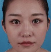 巫文云隆鼻真人案例对比分析技术贴：自然挺翘不雷同 width=