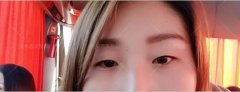 纳米微创双眼皮+开眼角前后对比图：愿意花钱投资自己 width=