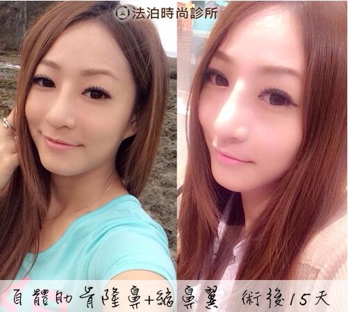 邱浚彦不光双眼皮做得好，隆鼻也很牛脾哦~