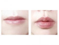 玻尿酸丰唇后唇珠太小咋整呢? width=