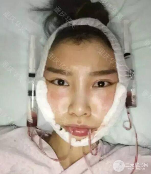 磨颧骨前后对比图，从此爱上了自拍