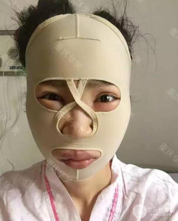 磨颧骨前后对比图，从此爱上了自拍