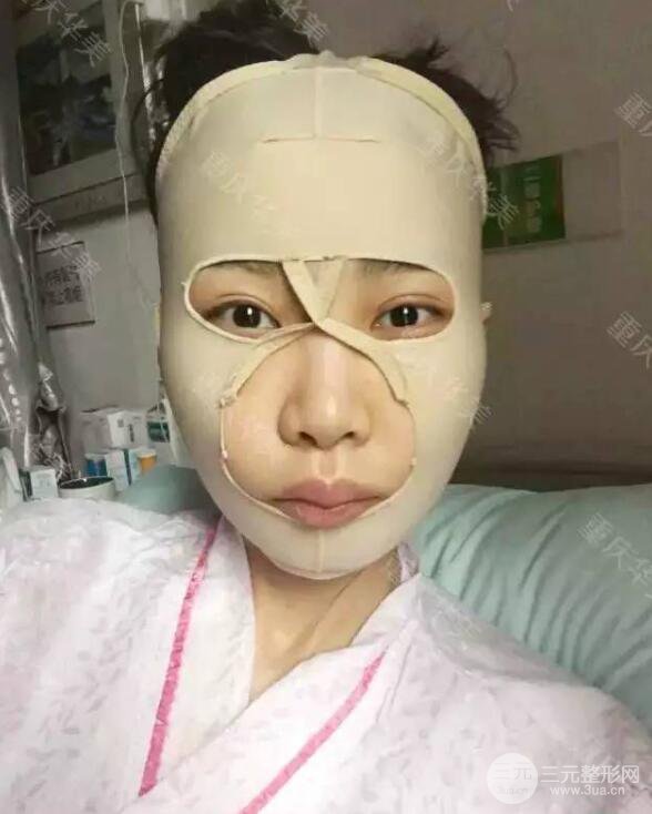 磨颧骨前后对比图，从此爱上了自拍