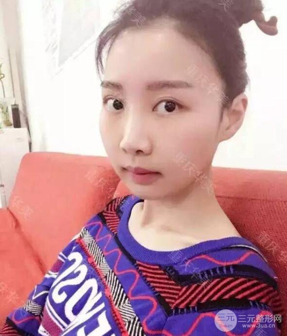 磨颧骨前后对比图，从此爱上了自拍