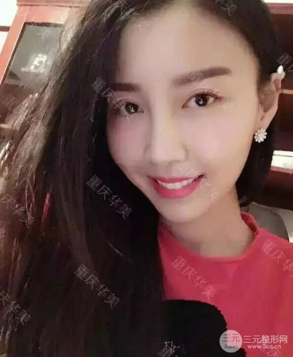 磨颧骨前后对比图，从此爱上了自拍