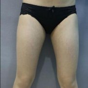 蔡国威医生大腿吸脂36天对比图：大象腿变筷子腿 width=